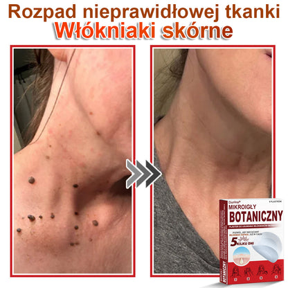 Dorina® Mikroigłowy botaniczny środek do usuwania narośli skórnych ✅✅✅wyprodukowano w Polsce