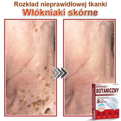 Dorina® Mikroigłowy botaniczny środek do usuwania narośli skórnych ✅✅✅wyprodukowano w Polsce