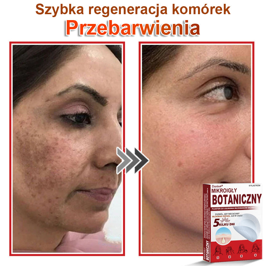 Dorina® Mikroigłowy botaniczny środek do usuwania narośli skórnych ✅✅✅wyprodukowano w Polsce