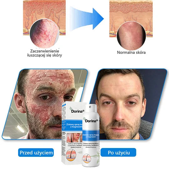 Oficjalny sklep✅: Dorina®Magnezowy spray ziołowy na łuszczycę✨